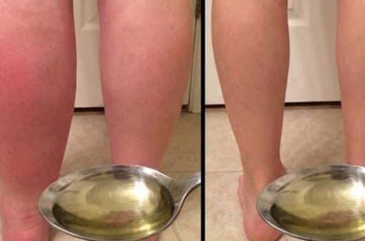 receita caseira para acabar com perna inchada