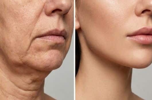 Receita caseira para eliminar rugas: cuidado fácil